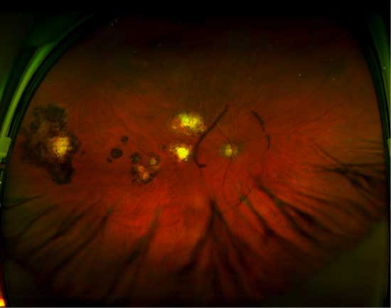 toxoplasmosis retina