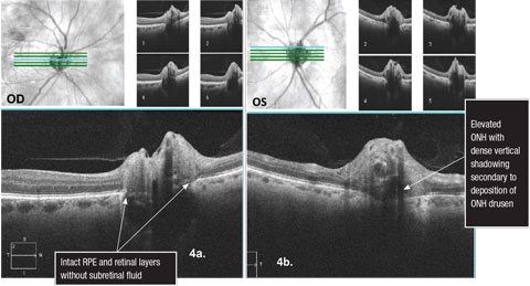 Figs. 4a and 4b. 5 line raster Cirrus SD-OCT scans over the optic nerves illustrating optic nerve head drusen.